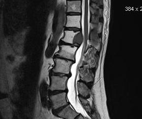 MRI Spine Proton Density